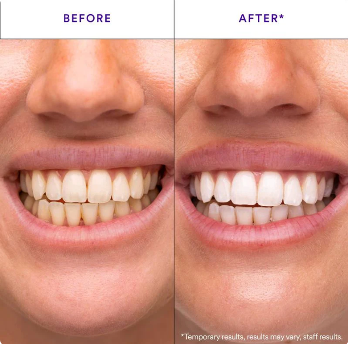 Teeth Whitening Strips