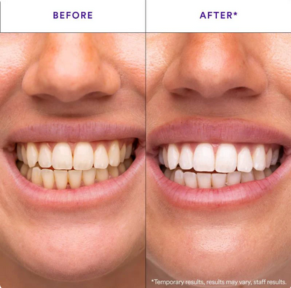 Teeth Whitening Strips